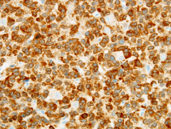 10D Oligodendroglioma (Case 10) IDH1 1