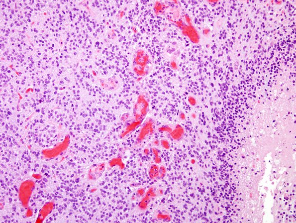 11A3 GBM, small cell features (Case 10) H&E 5.jpg