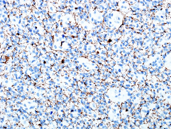 12D GBM, small-cell type (Case 12) NF 1