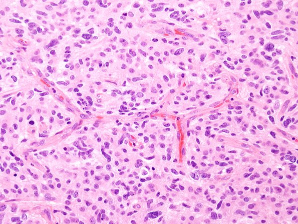 13A3 GBM, small cell (Case 13) H&E 8.jpg