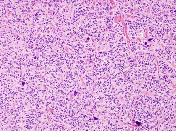 14A1 Glioblastoma, Small Cell (Case 14) H&E 8