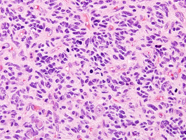 14A2 Glioblastoma, Small Cell (Case 14) H&E 4