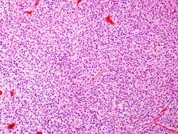 15A1 GBM, small cell (Case 15) H&E 5.jpg