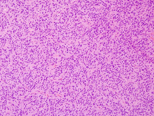 16B1 GBM, small cell type (Case 16) H&E 5.jpg