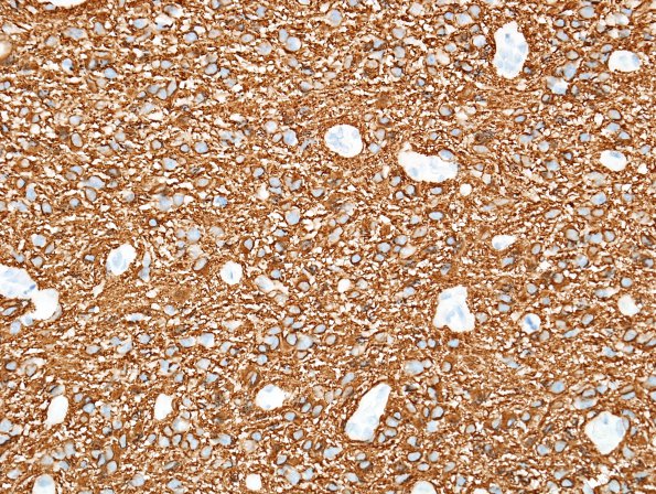 16C GBM, small cell type (Case 16) GFAP 1.jpg