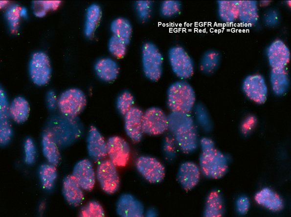 16E GBM, small cell type (Case 16) EGFR