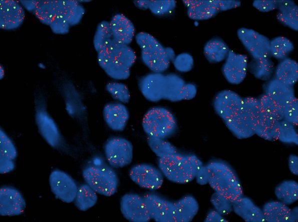 17B GBM, small cell type (Case 17) EGFR