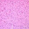 18B3 GBM, small cell type (Case 18) H&E 6.jpg