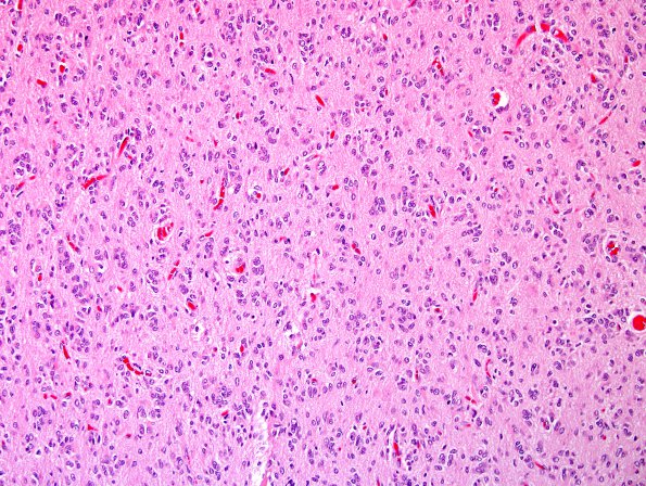 18B3 GBM, small cell type (Case 18) H&E 6.jpg