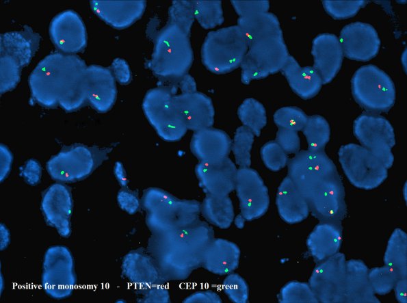 18C1 GBM, small cell type (Case 18) PTEN block B4