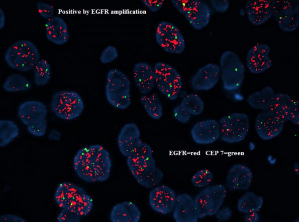 18C2 GBM, small cell type (Case 18) EGFR block A2