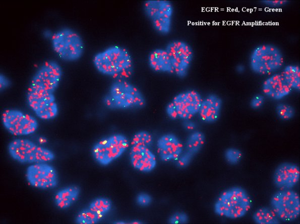 19B1 GBM, small cell variant (Case 19) EGFR - 2