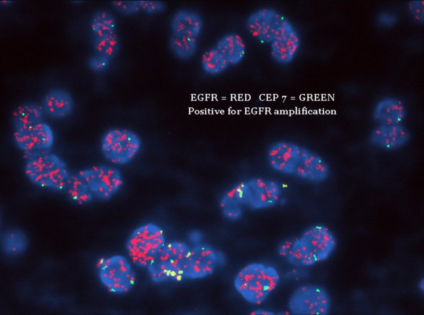 19B2 GBM, small cell variant (Case 19) EGFR - 1