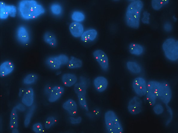 1B1 GBM, small cell features, focal (Case 1) FISH Poly 1