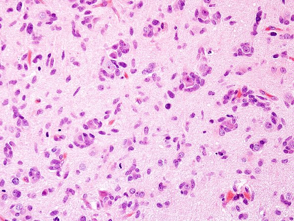 21A3 GBM, small cell variant (Case 21) H&E 5.jpg