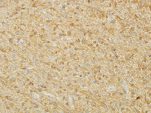 21B GBM, small cell variant (Case 21) GFAP 2.jpg