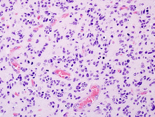 4A3 GBM , small cell features (Case 4) H&E 2.jpg