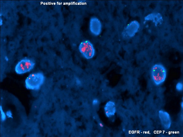 5C GBM, focal small cell (Case 5) EGFR