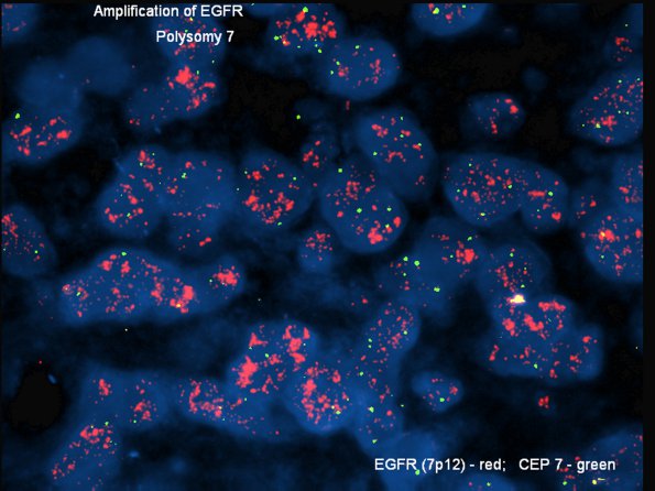 6D3 GBM, small cell (Case 6) EGFR-CEP7