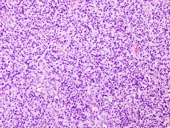 7A3 GBM, small cell features (Case 7) H&E 6.jpg