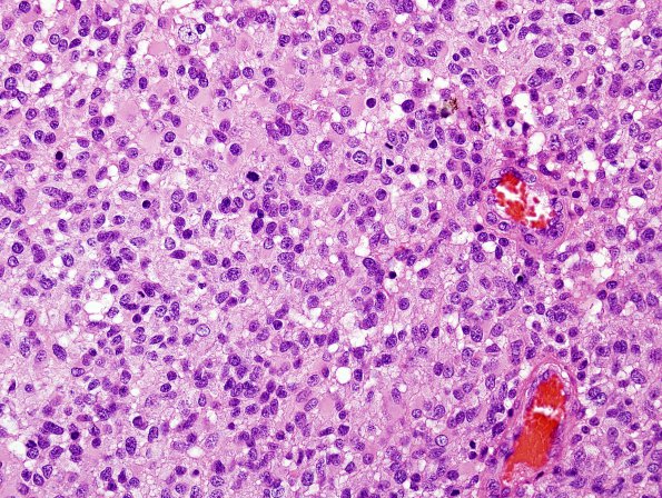 7A4 GBM, small cell features (Case 7) H&E 4.jpg