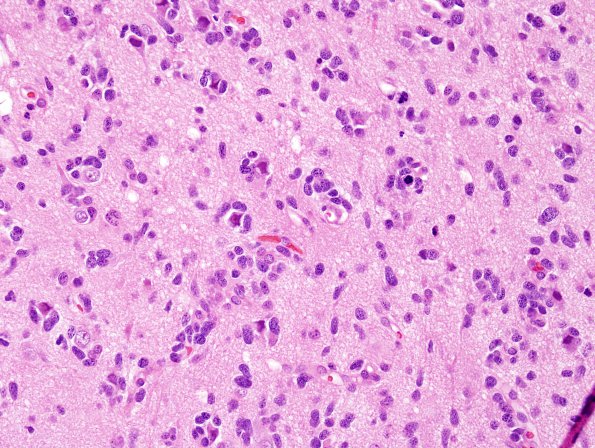 9A1 GBM, small cell subtype (Case 9) H&E 9.jpg