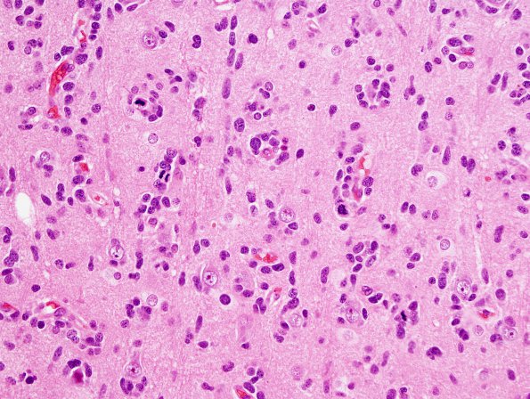 9A2 GBM, small cell subtype (Case 9) H&E 5.jpg