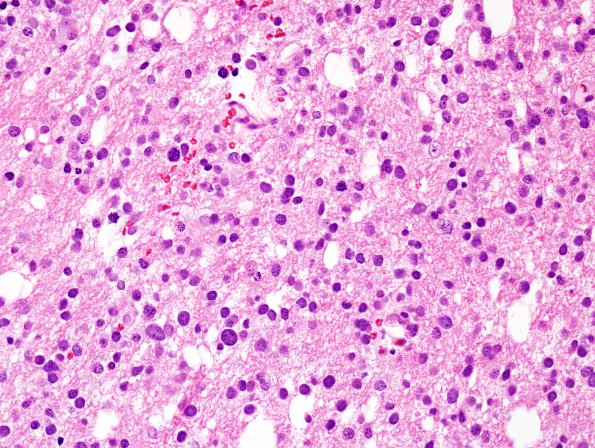 9A3 GBM, small cell subtype (Case 9) H&E 4.jpg