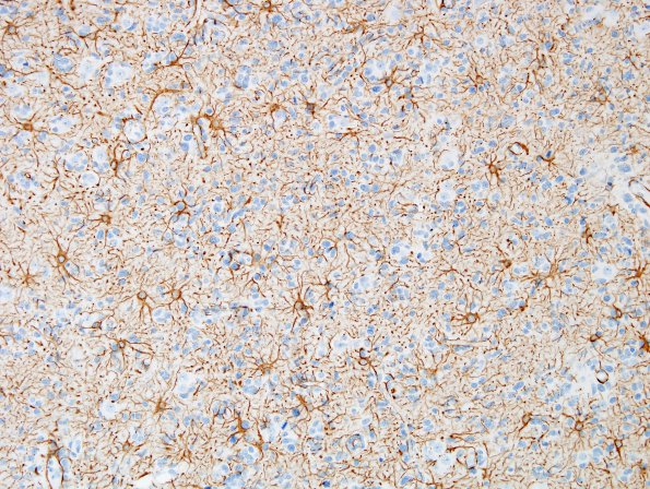 9B1 GBM, small cell subtype (Case 9) GFAP 5.jpg