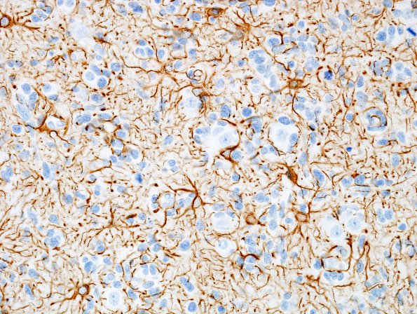 9B2 GBM, small cell subtype (Case 9) GFAP 2.jpg