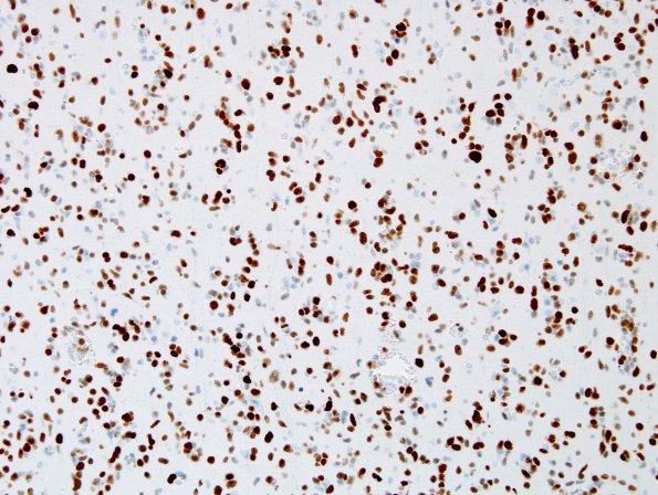 9D GBM, small cell subtype (Case 9) p53 2.jpg