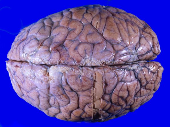 1A1 Astrocytoma, diffuse (Case 1) A 5