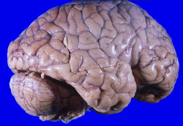 1A2 Astrocytoma, diffuse (Case 1) A 9