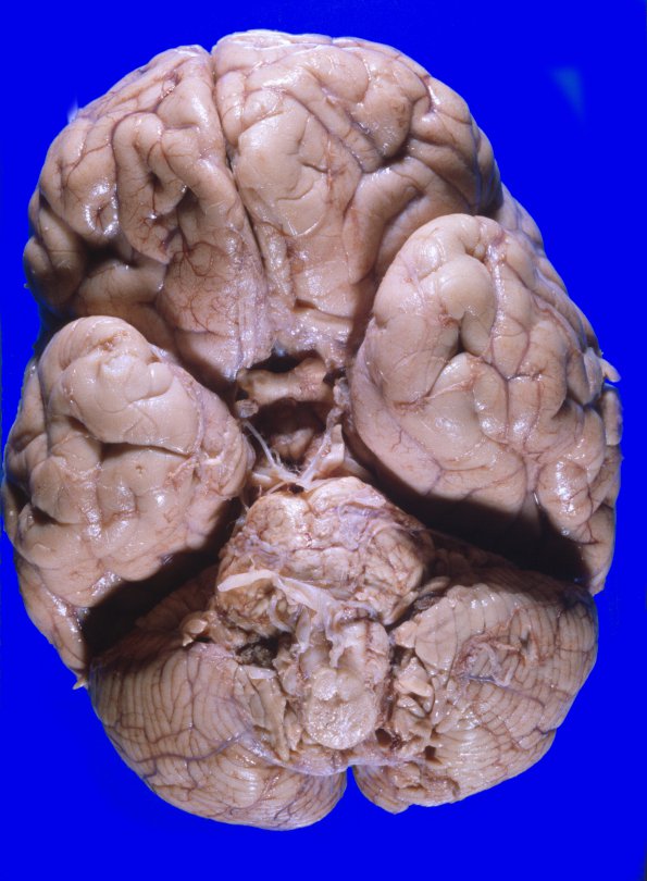 1A3 Astrocytoma, diffuse (Case 1) A 3