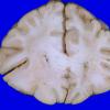 1A4 Astrocytoma, diffuse (Case 1) A 1