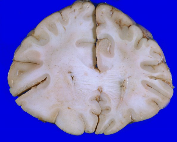 1A4 Astrocytoma, diffuse (Case 1) A 1