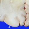 1A5 Gliomatosis Cerebr1A12 (Case 1) focal GBM gross 4 copy