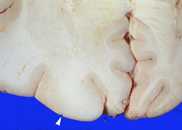 1A5 Gliomatosis Cerebr1A12 (Case 1) focal GBM gross 4 copy