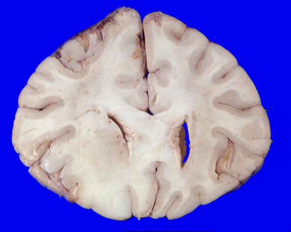 1A6 Gliomatosis Cerebri 1A14 (Case 1), focal GBM gross 12