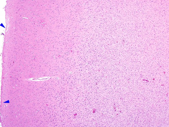 1B2 Astrocytoma, diffuse (Case 1) H&E frontal cortex 6 copy