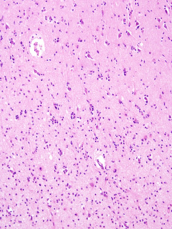 1B3 Astrocytoma, diffuse (Case 1) H&E frontal cortex 5