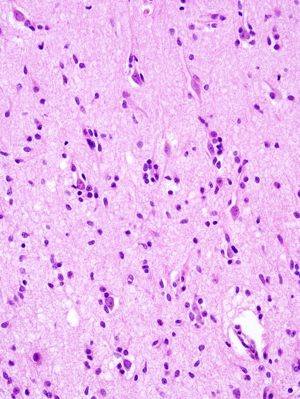 1B4 Astrocytoma, diffuse (Case 1) H&E frontal cortex 4