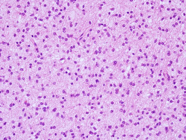 1B5 Astrocytoma, diffuse (Case 1) H&E frontal cortex 1