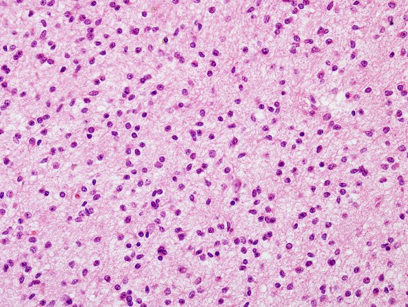 1B6 Gliomatosis Cerebri (Case 1), focal GBM H&E 1