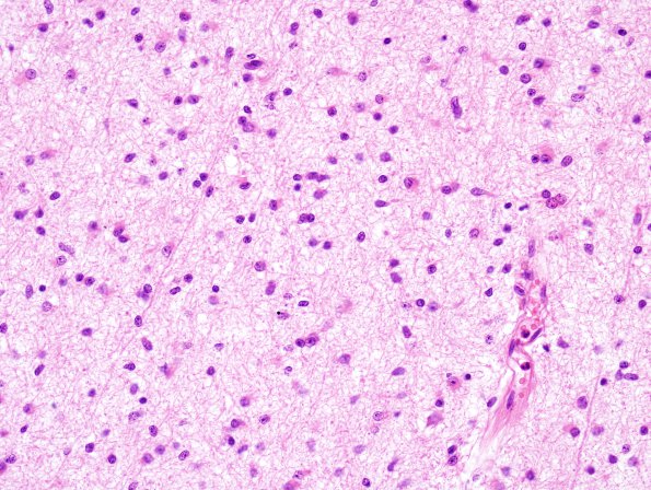 1B7 Astrocytoma, diffuse (Case 1) H&E frontal cortex 2