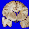 1C1 Gliomatosis Cerebri (Case 1), gross 8 (2)