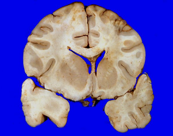 1C1 Gliomatosis Cerebri (Case 1), gross 8 (2)