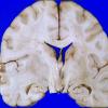 1C2 Astrocytoma, diffuse (Case 1) A 6