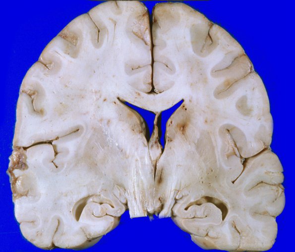 1C2 Astrocytoma, diffuse (Case 1) A 6