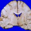 1C3 Astrocytoma, diffuse (Case 1) A 7